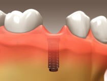 Dental Implants - Scarborough Dentist - Dr. Sara Razmavar - Highland Creek Dental - Illustration 4