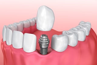 dental-implants-blurb-320x213l