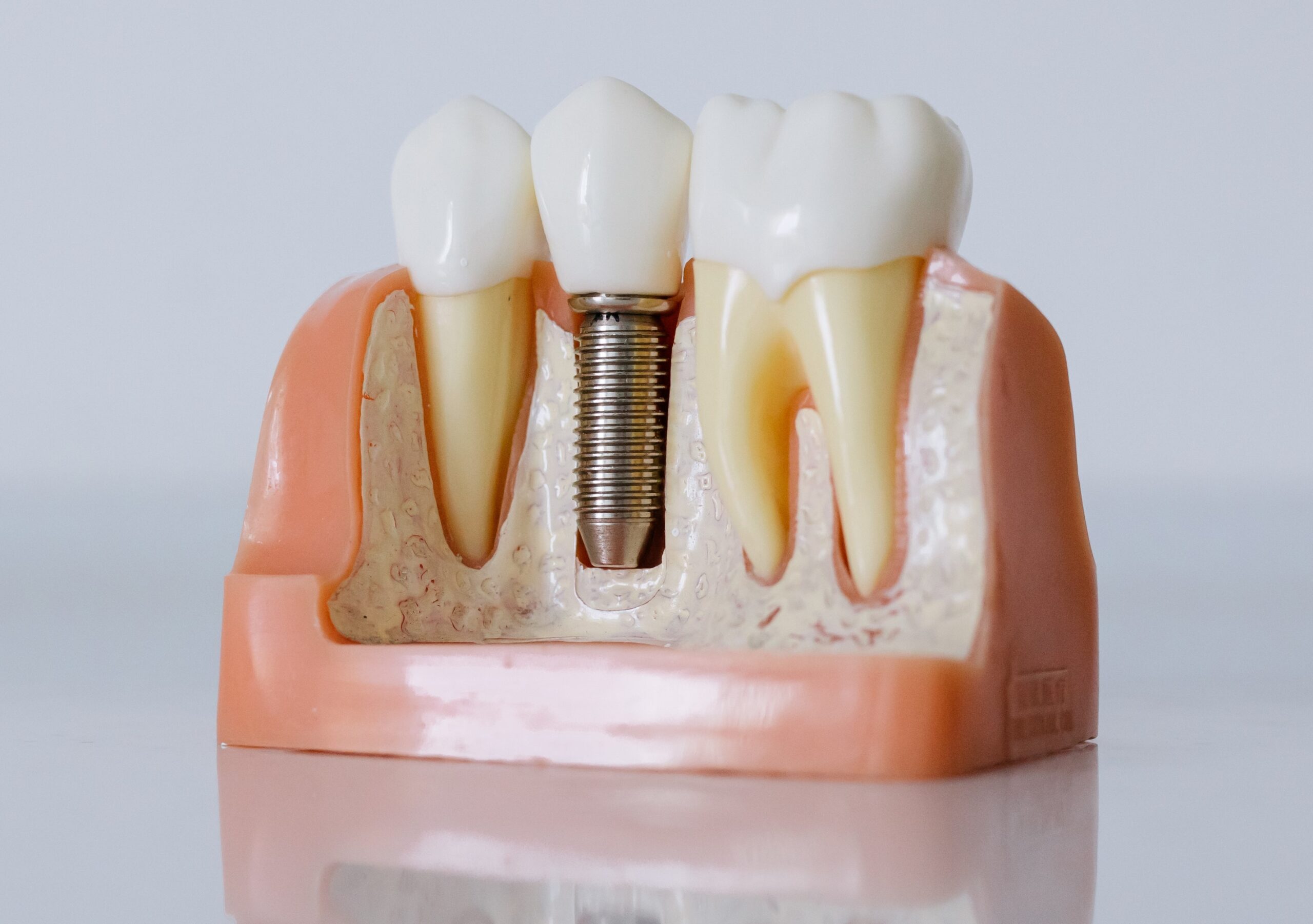 Dental Implants TLC Dental Care