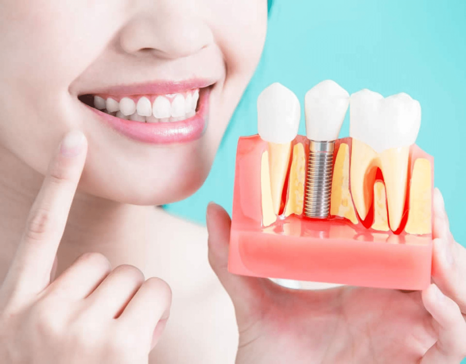 Dental Implants in Calgary