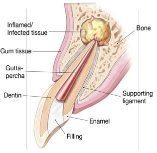 endodontic surgery