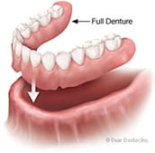 full-denture