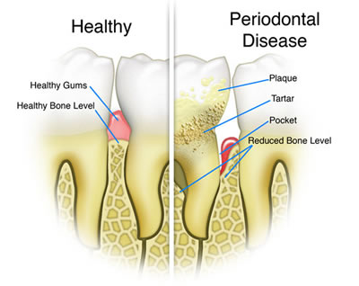 gumdisease