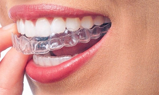 invisalign-retainer