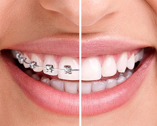 invislaign-vs-traditional