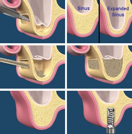 sinus lift